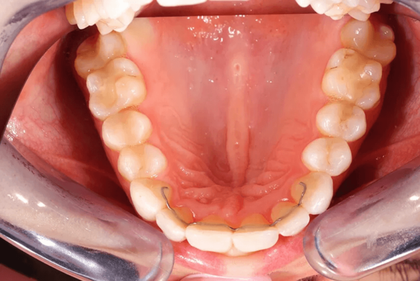 invisalign_nachher_oberkiefe.png