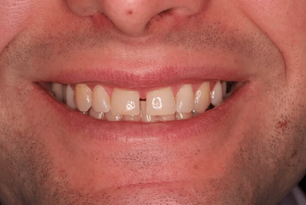 veneers_vorher.png