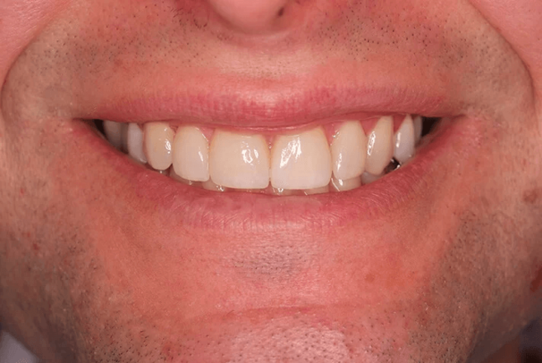 veneers_nachher_2.png