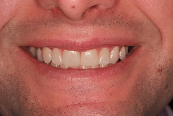 veneers_nachher_1.png