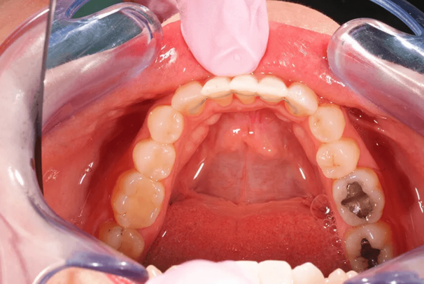 invisalign_nachher_unterkiefer.png