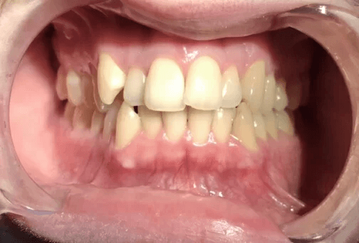 invisalign_vorher.png